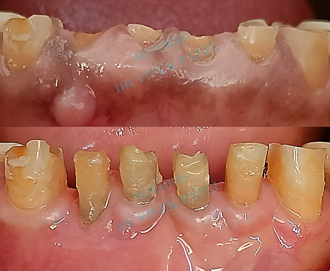 Crown lengthening clinical case