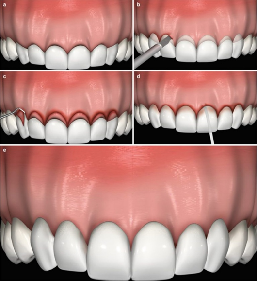 Crown lengthening illustration