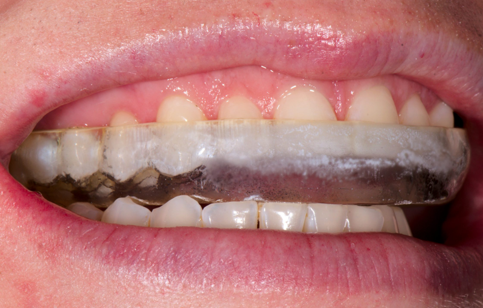 Night guard appliance for teeth grinding (bruxism) - Novoris Ahmedabad
